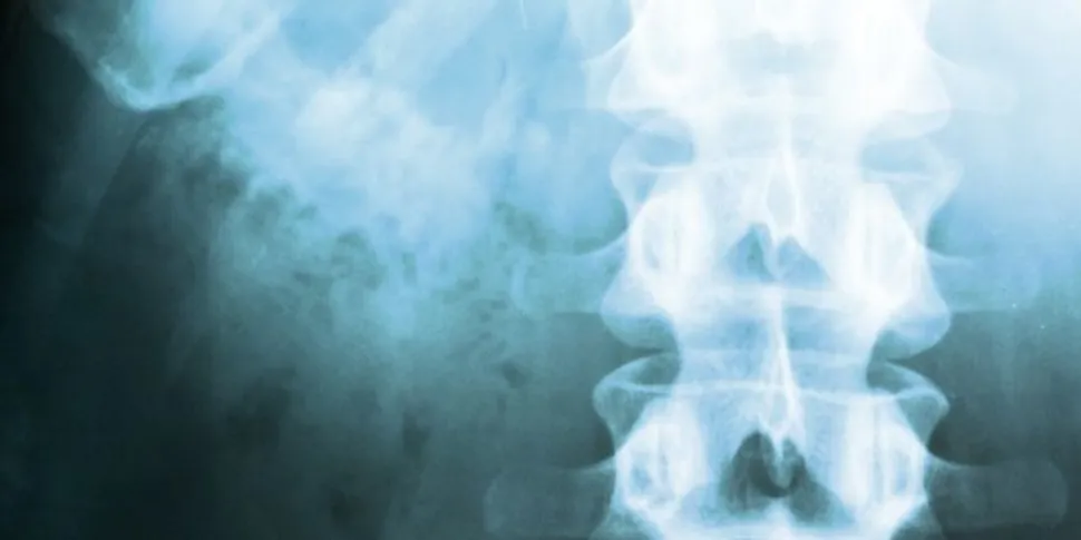 Can Myeloma Bone Damage Be Repaired? image