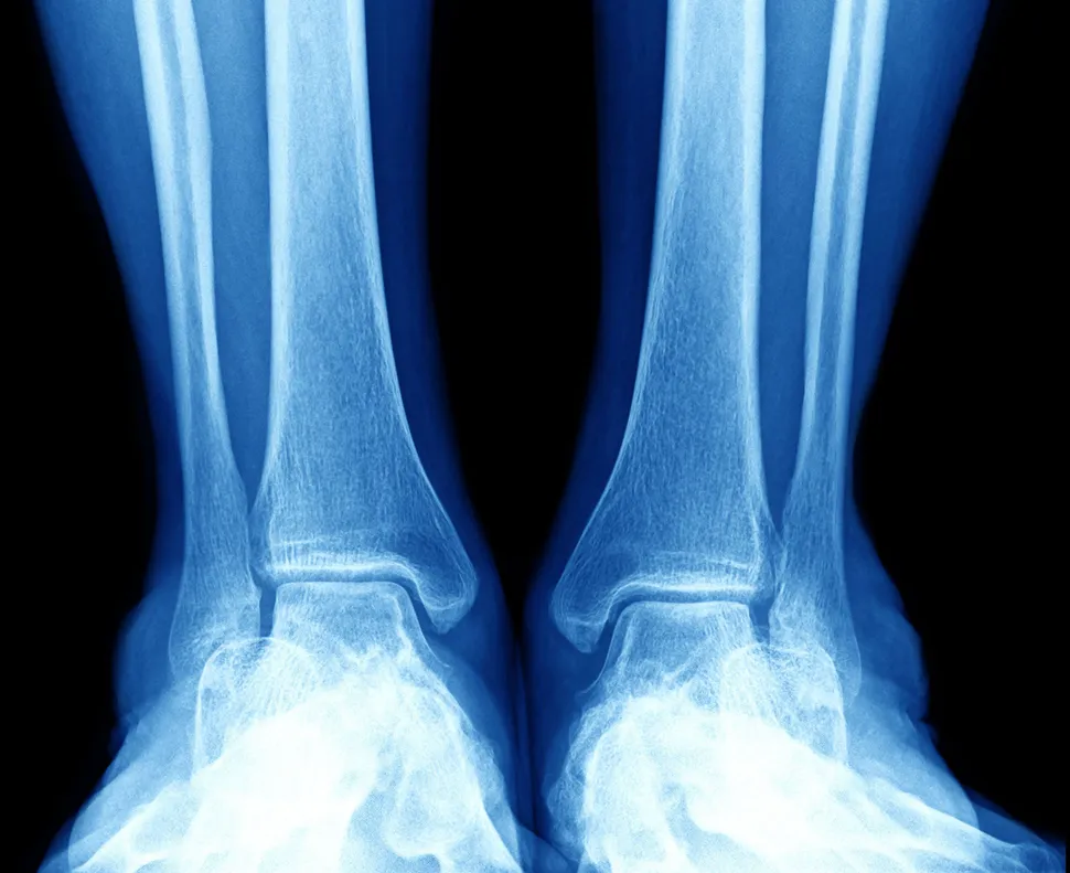 New Bone Strengthener Shows Greater Anti-Myeloma Effect and Convenience image